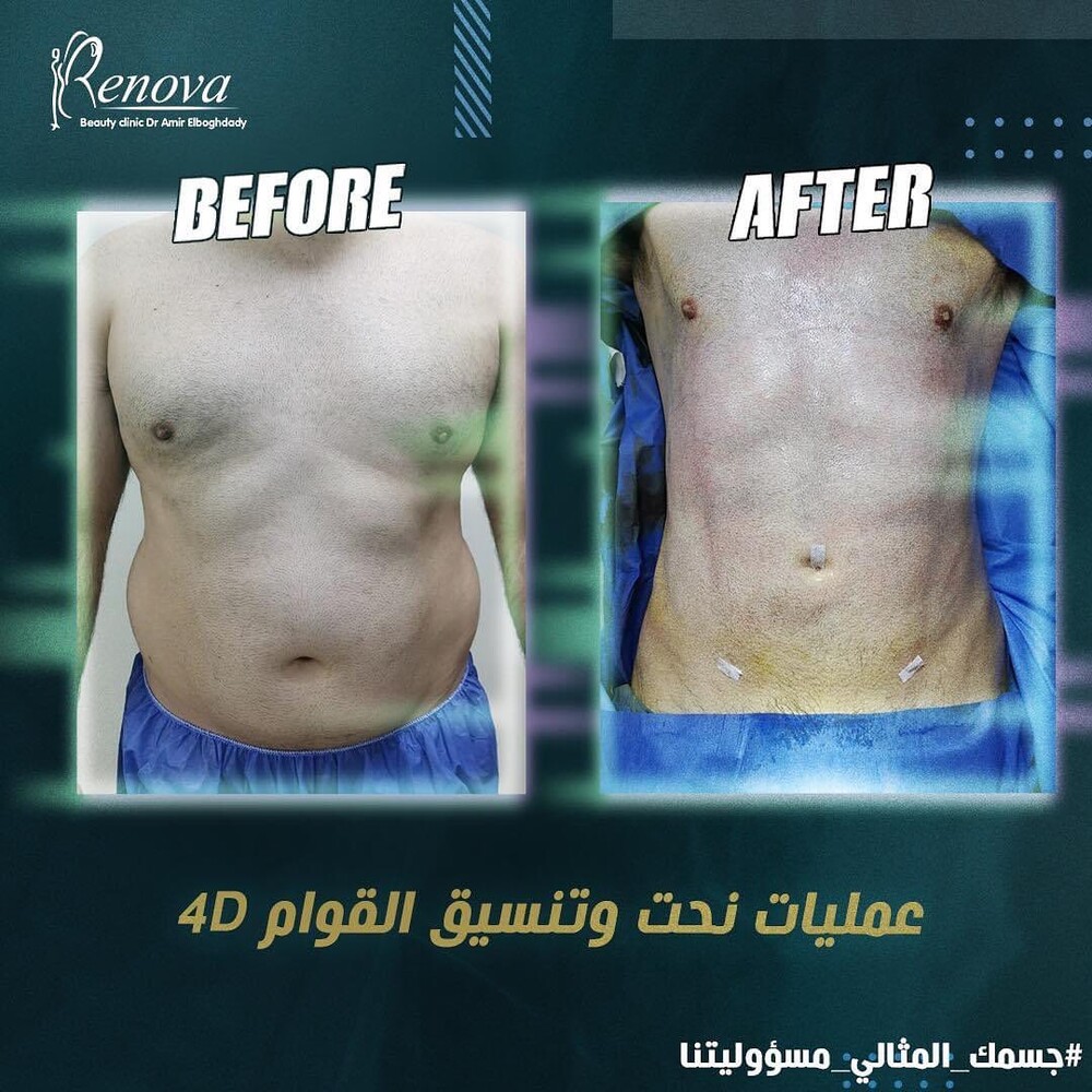 Before and After Result